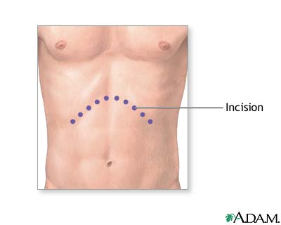 Incision