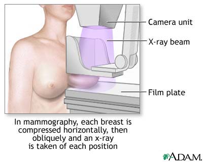 Mammography Mammography