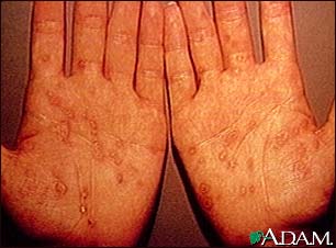 Syphilis, secondary on the palms Syphilis, secondary on the palms