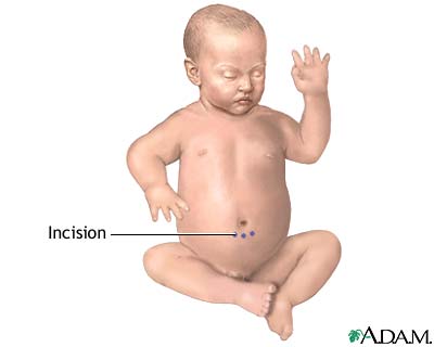 Incision