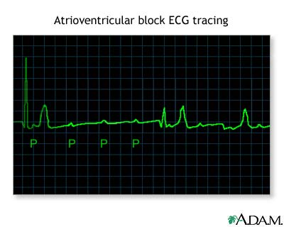 Atrioventricular block, ECG tracing Atrioventricular block, ECG tracing