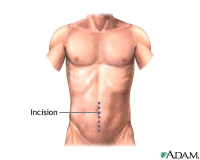Incision