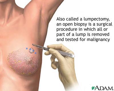 Open biopsy of the breast Open biopsy of the breast