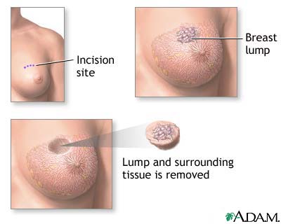 Lumpectomy Lumpectomy