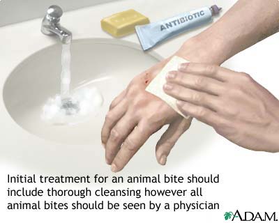 Animal bites Animal bites
