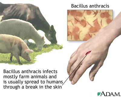 Cutaneous anthrax Cutaneous anthrax