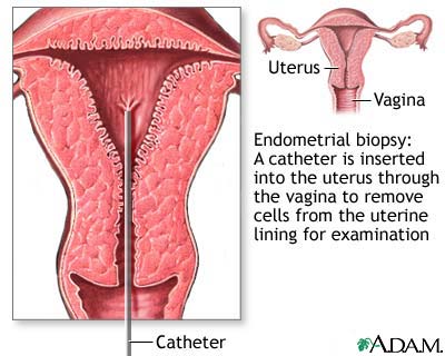 Endometrial biopsy Endometrial biopsy
