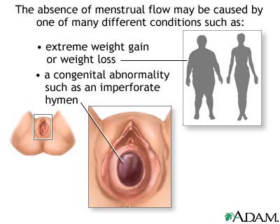 Absence of menstruation (amenorrhea) Absence of menstruation (amenorrhea)