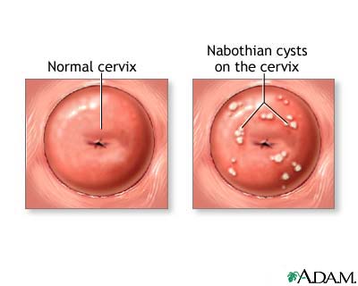 Nabothian cyst Nabothian cyst