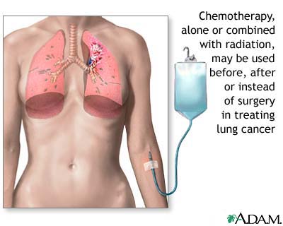 Lung cancer - chemotherapy treatment Lung cancer - chemotherapy treatment