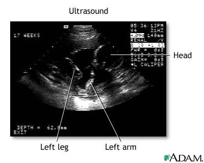 Ultrasound, normal fetus- ventricles of brain Ultrasound, normal fetus- ventricles of brain