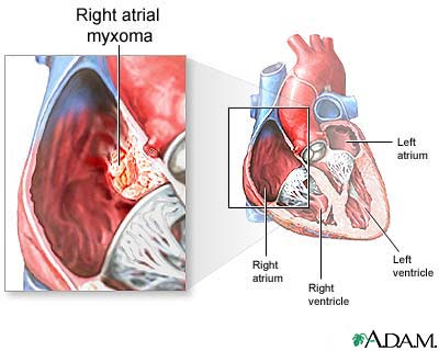 Right atrial myxoma Right atrial myxoma