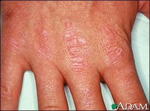 Dermatomyositis, Gottron's papules on the hand Dermatomyositis, Gottron's papules on the hand
