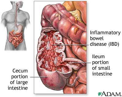 Inflammatory bowel disease Inflammatory bowel disease