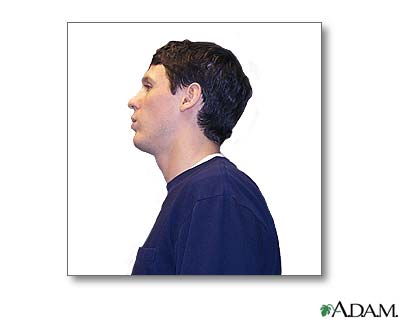 Metered dose inhaler use - part three