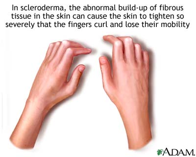 Sclerodactyly Sclerodactyly