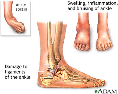 Ankle sprain Ankle sprain