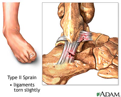 Type II ankle sprain