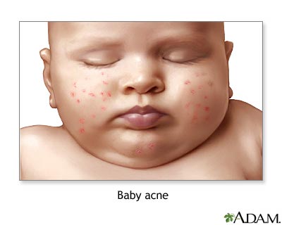 Baby acne Baby acne