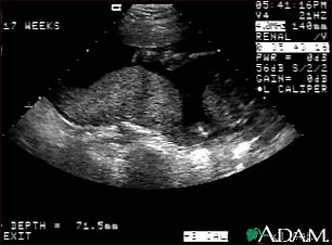 Ultrasound, normal placenta - Braxton Hicks Ultrasound, normal placenta - Braxton Hicks