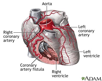 Coronary artery fistula Coronary artery fistula