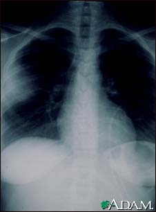 Aspergillosis - chest X-ray Aspergillosis - chest X-ray
