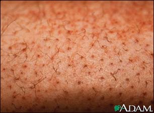 Scurvy, corkscrew hair