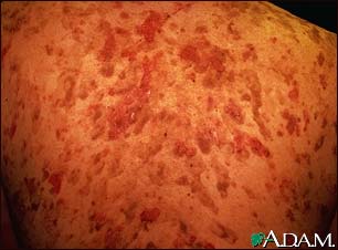 Pemphigus, vulgaris on the back Pemphigus, vulgaris on the back