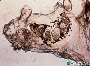 Scabies mite, eggs, and stool photomicrograph Scabies mite, eggs, and stool photomicrograph