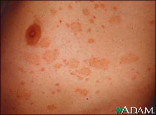 Pityriasis rosea on the chest Pityriasis rosea on the chest