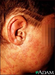 Psoriasis, guttate on the cheek Psoriasis, guttate on the cheek