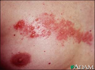 Herpes zoster (shingles) on the chest Herpes zoster (shingles) on the chest