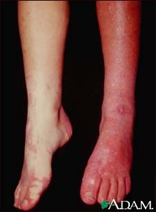 Sturge-Weber syndrome - legs Sturge-Weber syndrome - legs
