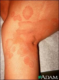 Ringworm, tinea corporis on the leg