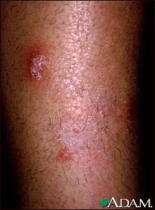 Granuloma, fungal (Majocchi's)