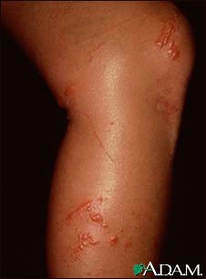 Poison ivy on the leg Poison ivy on the leg