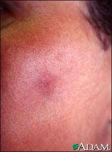 Fixed drug eruption on the cheek