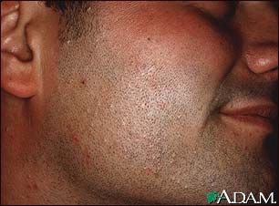 Molluscum contagiosum on the face