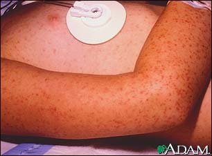 Rocky mountain spotted fever, petechial rash Rocky mountain spotted fever, petechial rash