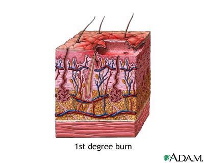 First degree burn