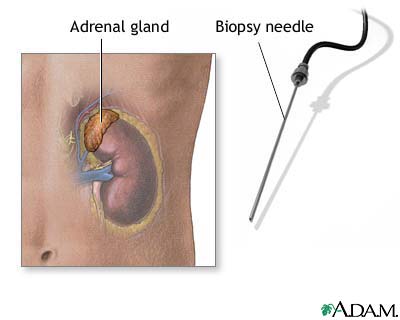 Adrenal gland biopsy Adrenal gland biopsy