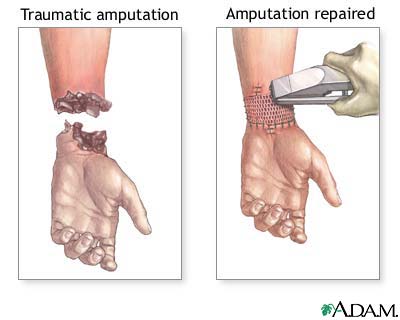 Amputation repair Amputation repair