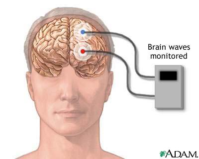 Brain wave monitor Brain wave monitor