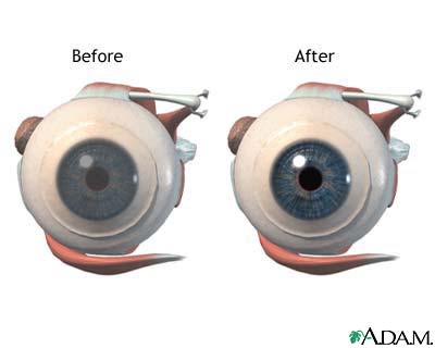 Before and after corneal surgery Before and after corneal surgery