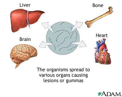 Late-stage syphilis Late-stage syphilis