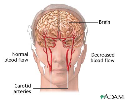 Transient Ischemic attack (TIA) Transient Ischemic attack (TIA)