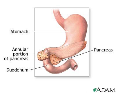 Annular pancreas Annular pancreas