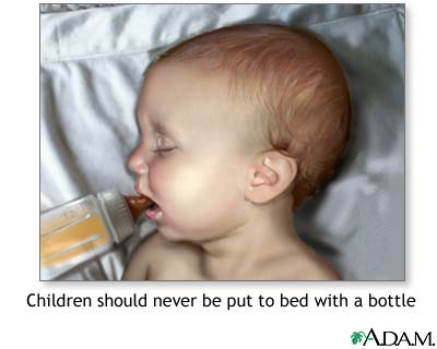 Baby bottle tooth decay Baby bottle tooth decay