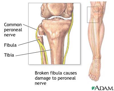 Common peroneal nerve dysfunction