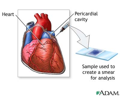 Pericardial fluid culture Pericardial fluid culture